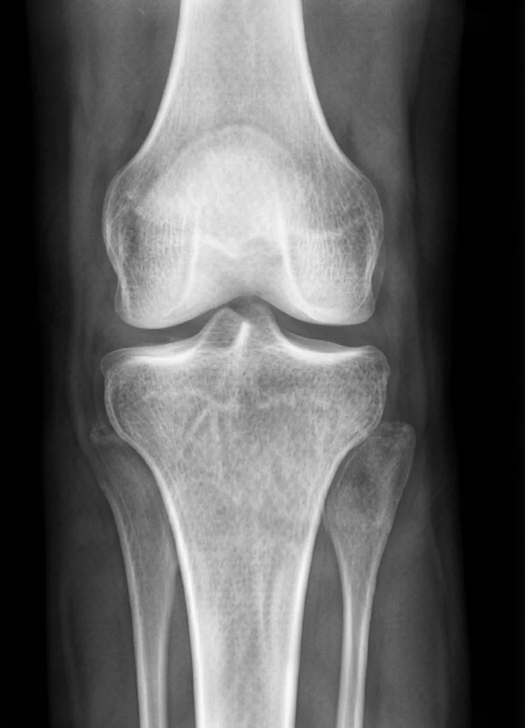 Anteroposterior knee radiograph showing the joint space between femur and tibia