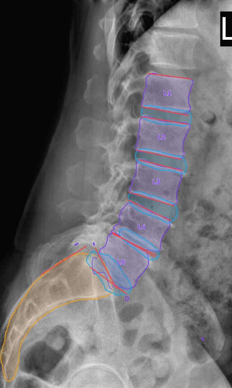 Lateral lumbar radiograph as segmented in the app: vertebrae L1 to L5, disc spaces and the sacrum outlined, with endplate lines