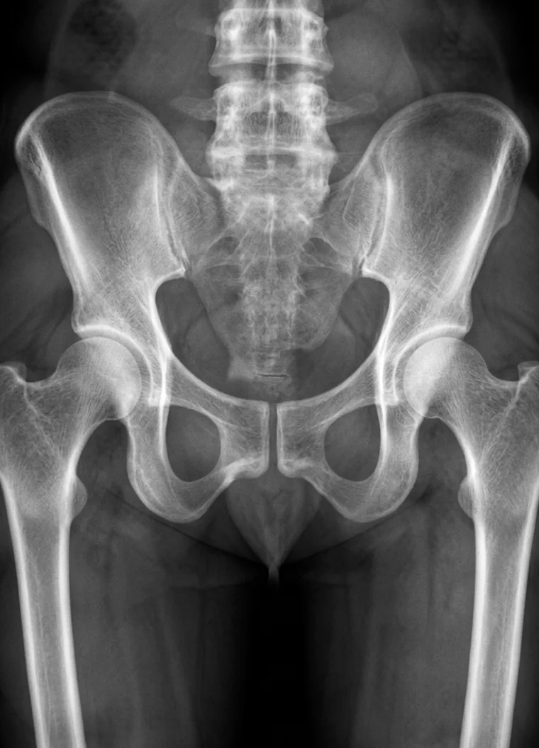 Anteroposterior pelvis radiograph showing both hip joints